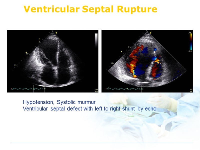 Ventricular Septal Rupture Hypotension, Systolic murmur Ventricular septal defect with left to right shunt